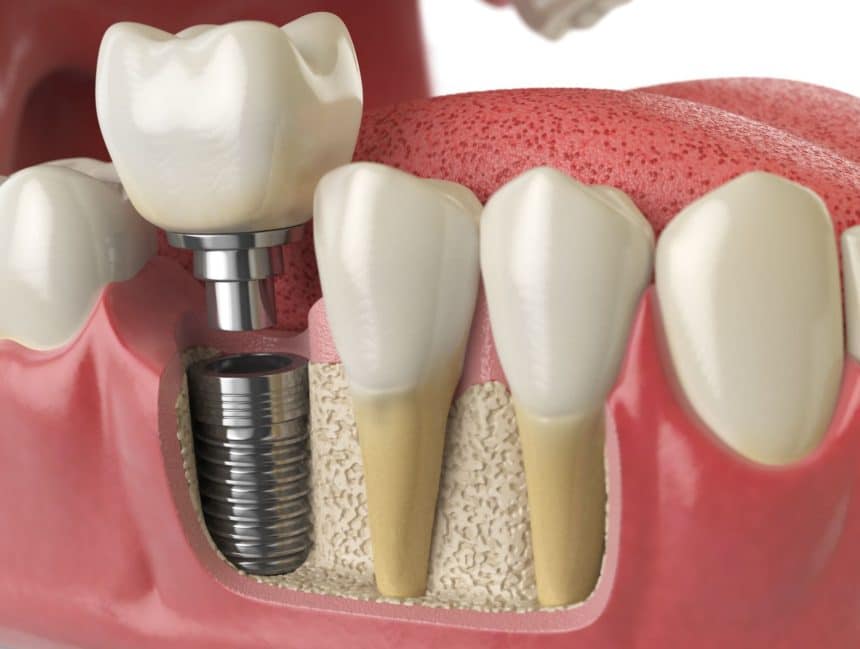 Are Dental Implants Right For You?