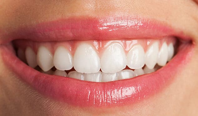 person smiling with veneers