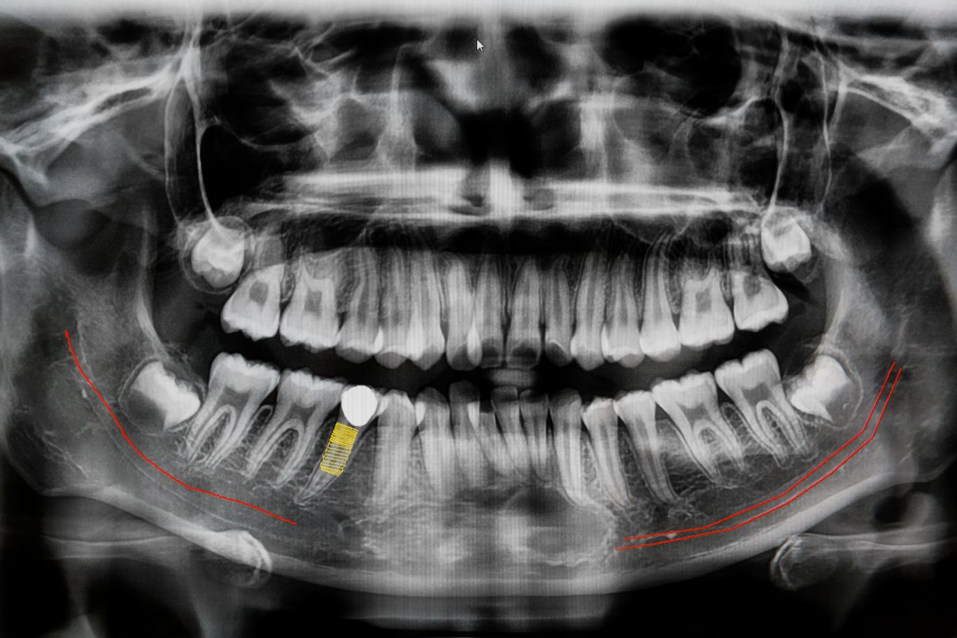 How often can you take dental X-rays and are they safe?