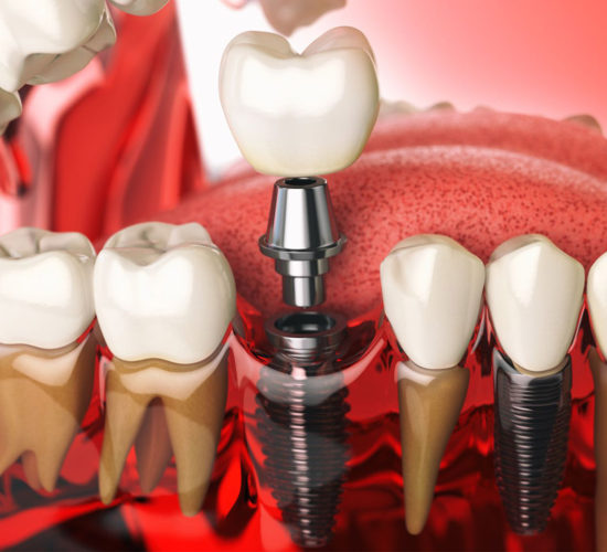 What’s new in dental implantology?