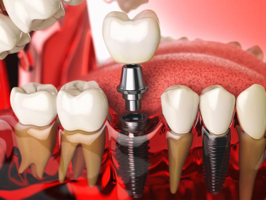 What’s new in dental implantology?