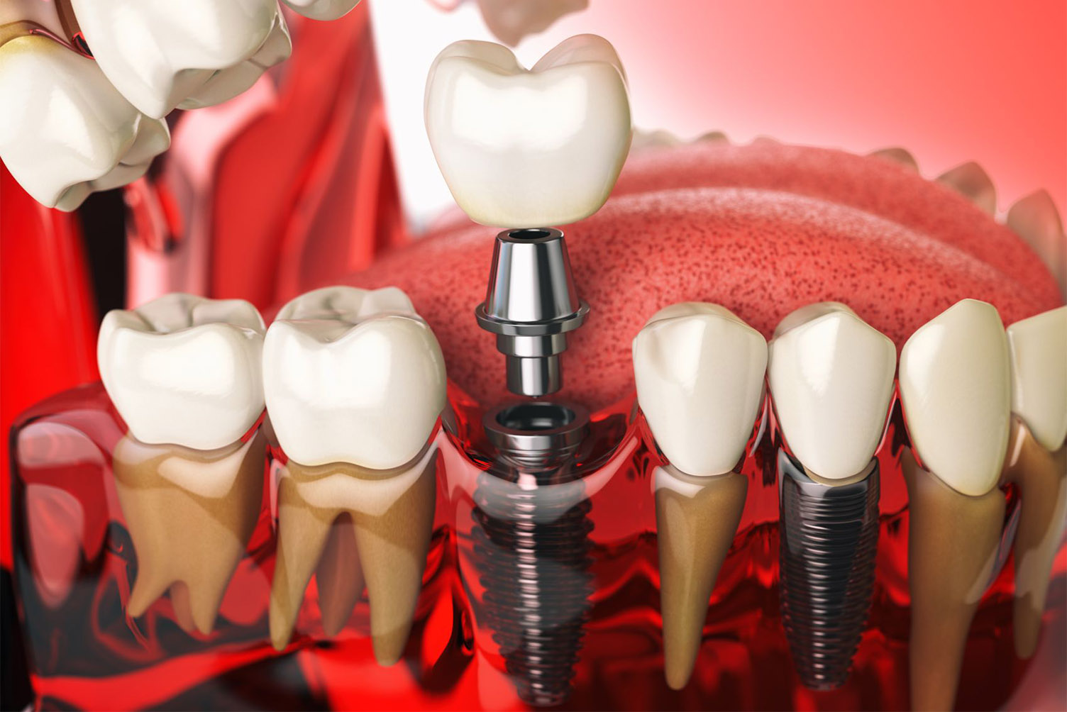 What’s new in dental implantology?