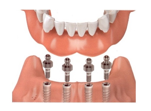dental implant near me, dentist near me