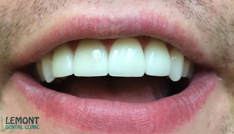 person smiling with veneers