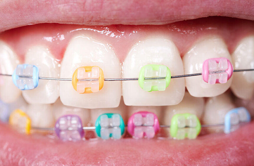 The Ultimate Braces Guide – How Much Do Braces Cost