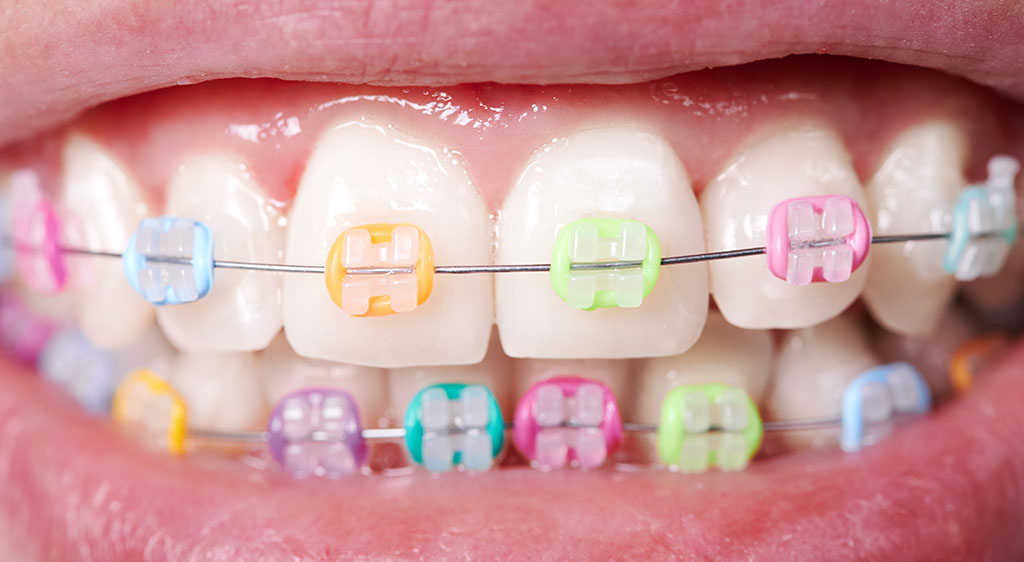 The Ultimate Braces Guide – How Much Do Braces Cost