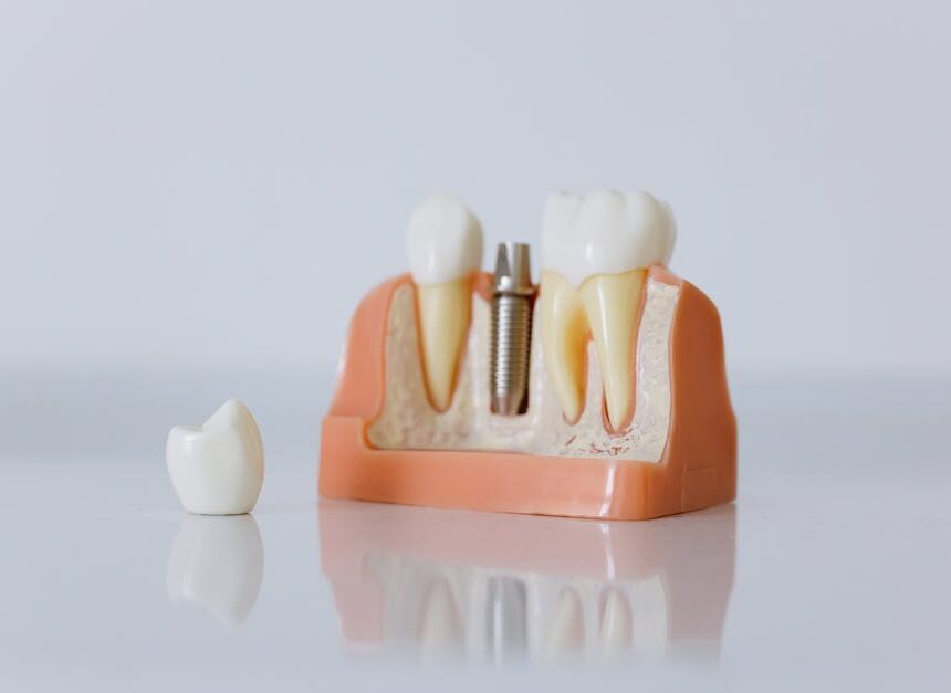 Where to Get Snap-On Dentures: A Local Search Guide
