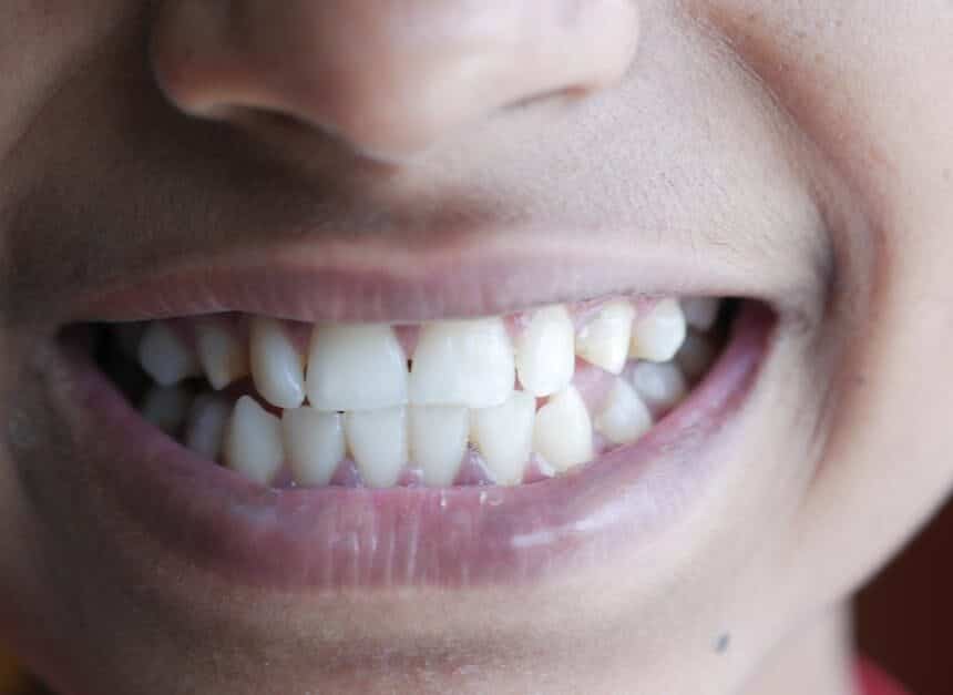 Dental Restoration: Unveiling the True Cost of a Healthy Smile