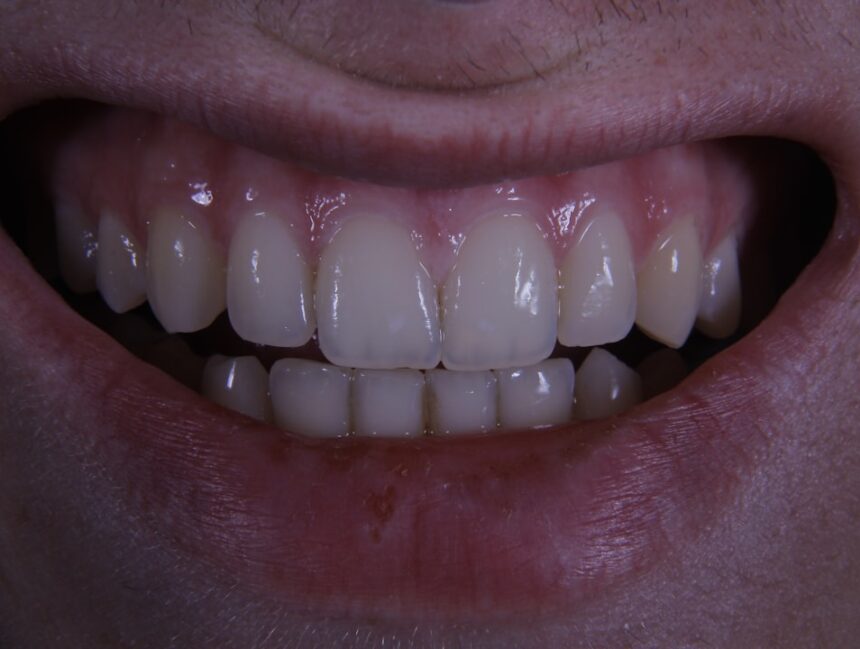 Can You Still Get an Implant After Years of a Missing Tooth?