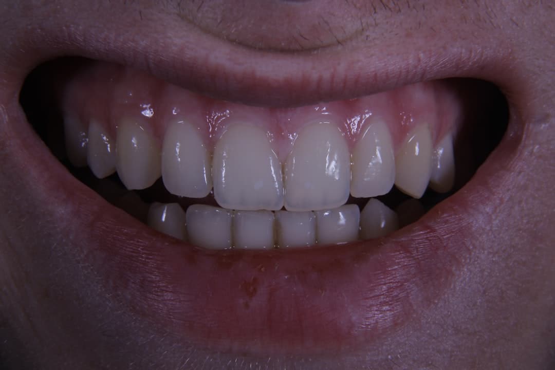 Can You Still Get an Implant After Years of a Missing Tooth?