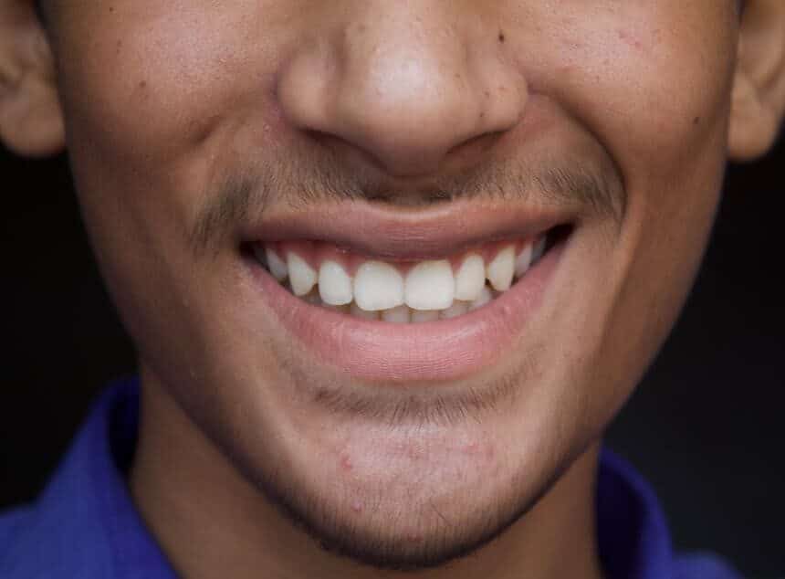 The Cost of Confidence: Making Permanent Teeth Affordable