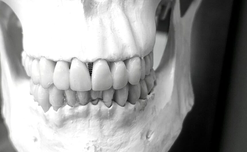 Bone Grafting for Dental Implants: What You Need to Know Before You Grow