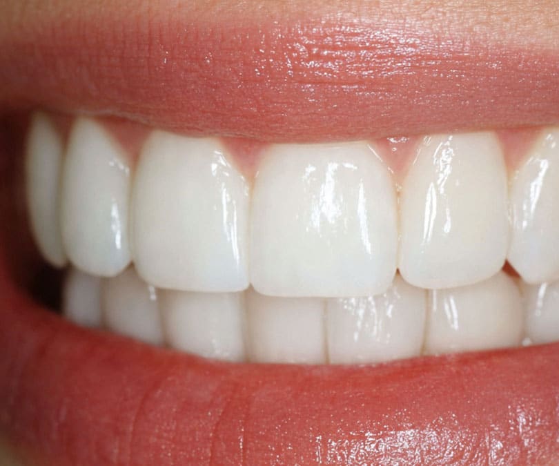 cosmetic dental bonding