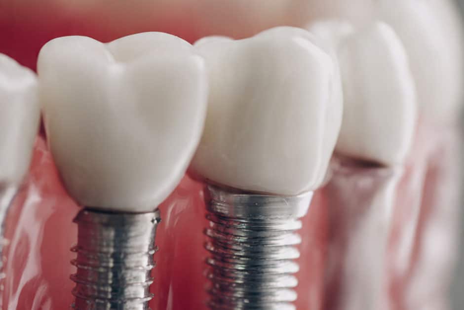dental implants lemont palos hills