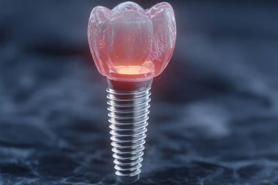 implant crowns lemont palos hills