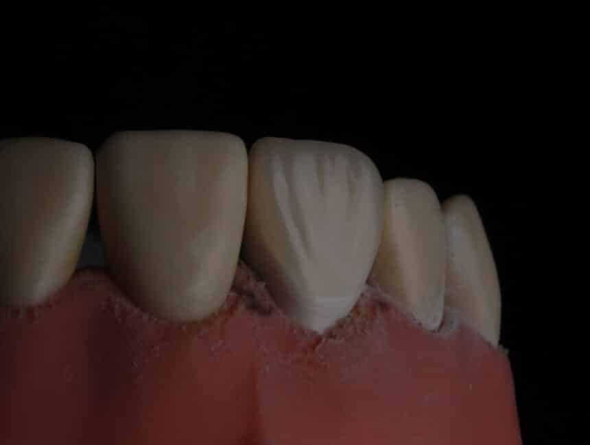 Bridges Implants and Flippers Oh My