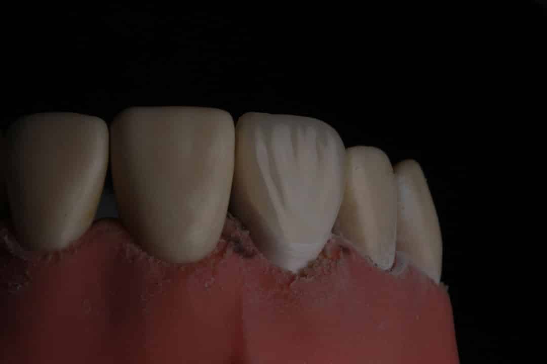 Bridges Implants and Flippers Oh My