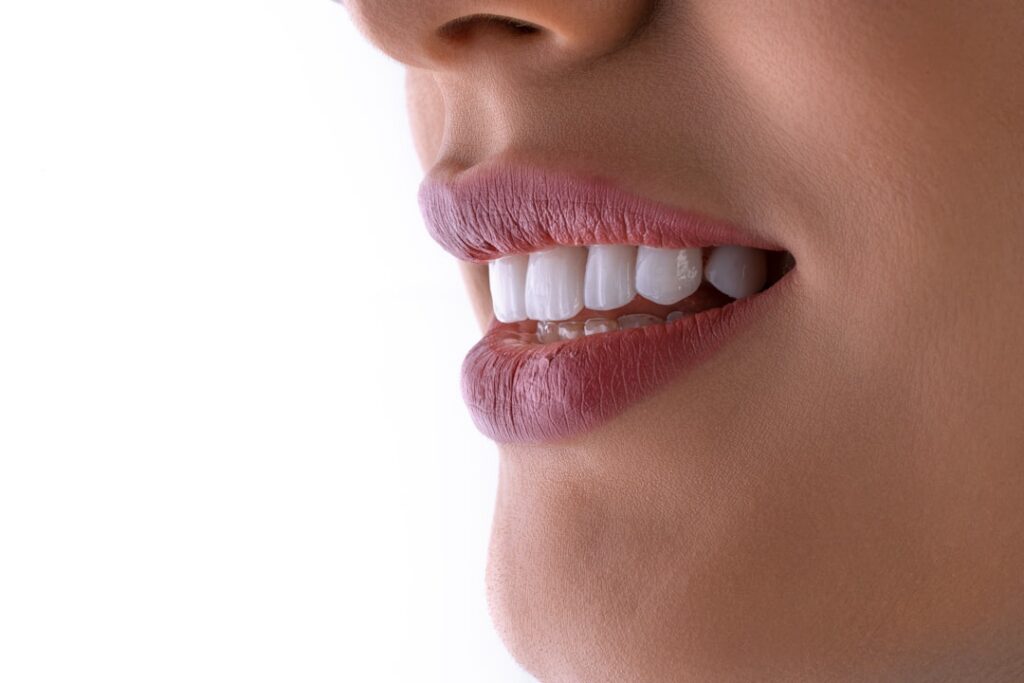 dental bonding for aesthetics