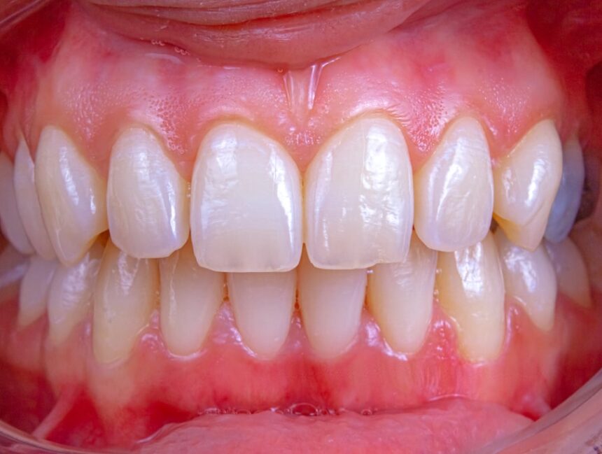 Affordable Gum Disease Solutions That Won’t Break the Bank