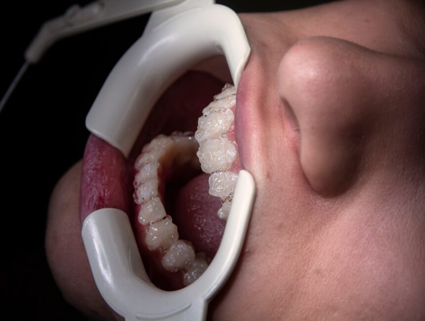 Front Teeth Dental Implants: Cost, Comfort, and Confidence