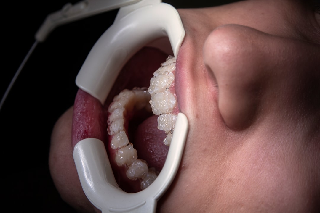 Front Teeth Dental Implants: Cost, Comfort, and Confidence