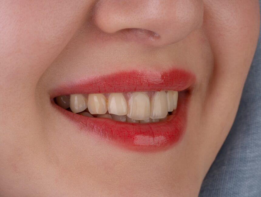 Hypodontia 101: Why Some Teeth Never Show Up