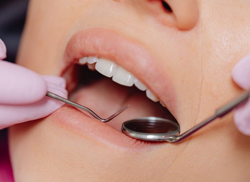 Plaque Removal Near Me: Your Guide to Professional Teeth Cleaning