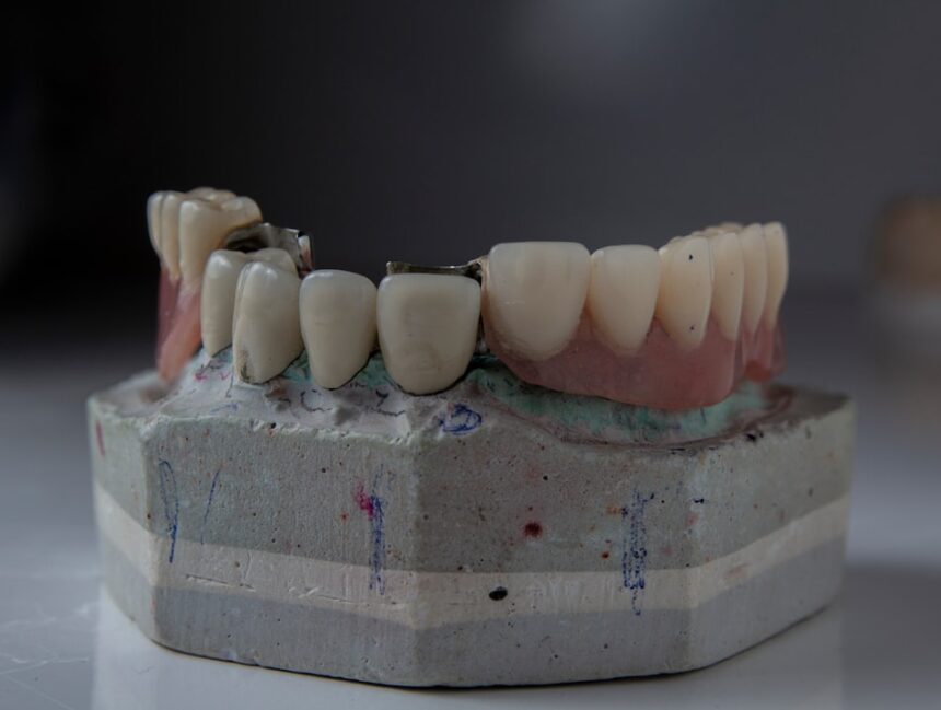 Temporary Teeth in All-on-4 Procedures: A Survival Guide