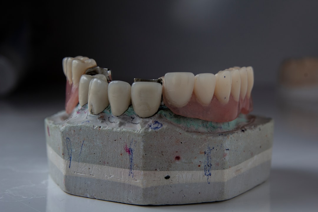 Temporary Teeth in All-on-4 Procedures: A Survival Guide
