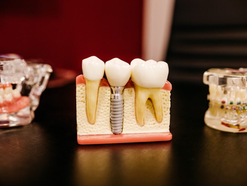 Beginner’s Guide to Dental Implants Cost