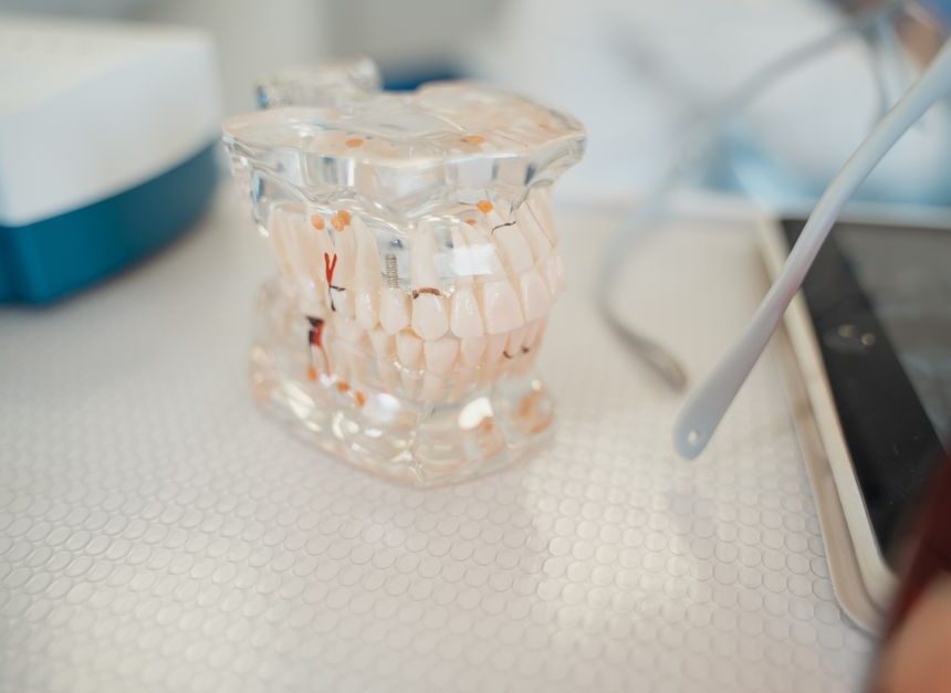 Save 30% on Dental Implants in Your Area