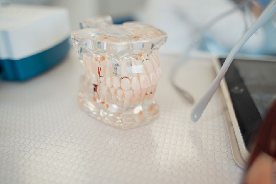Save 30% on Dental Implants in Your Area