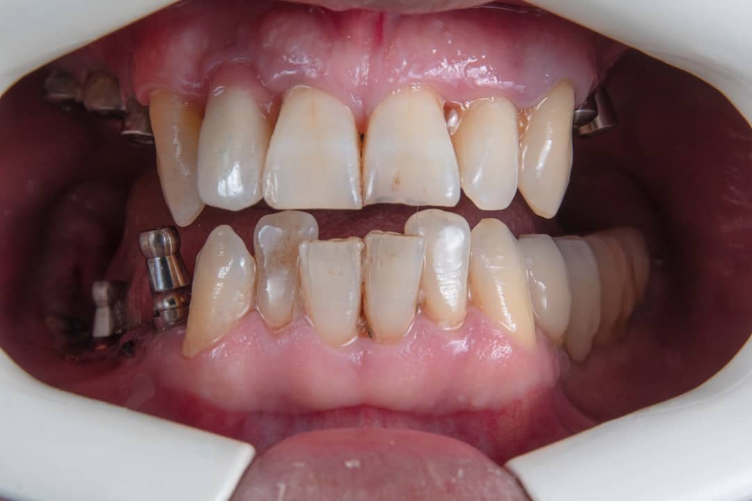 Everything You Need to Know About Full Arch Restoration