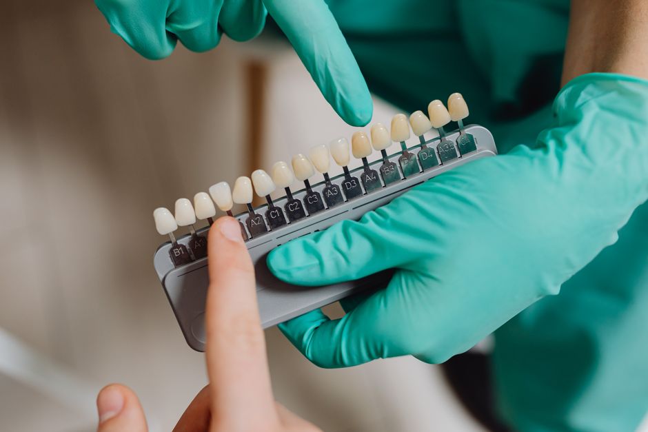 Local Dentist Teeth Whitening: Get a Brighter Smile Without the DIY Drama