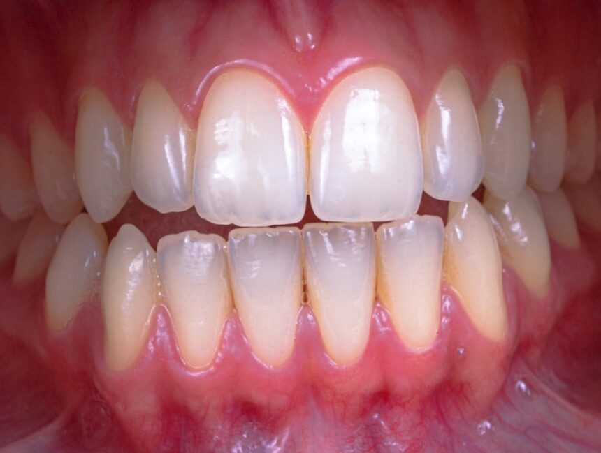 Scaling and Polishing for a Sparkly Smile