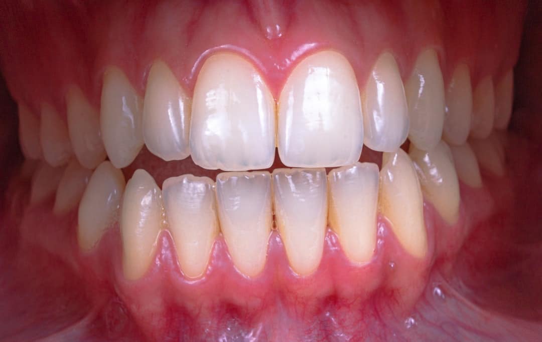 Scaling and Polishing for a Sparkly Smile