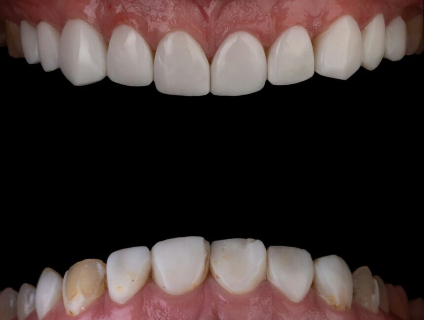 Affordable Teeth Whitening Near You: A Practical Guide to Budget Brightening