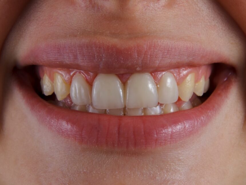 Don’t Scrape That! How to Handle Stubborn Tartar